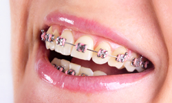 Types of Braces - Prairie Ridge Orthodontics